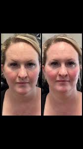 “Everything is sagging and I look tired.”, Subtle facial rebalancing with  Botox and dermal filler can make an incredible difference and still look  natural! , Questions? Let’s chat! , 254-308-2032, ...