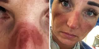 Nurses And Doctors Are Sharing The Graphic Effects Of Wearing Face Masks As  They Continue Fighting On The Front Lines Of The Coronavirus