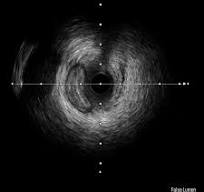 OPTICROSS™ HD Catéter para imágenes coronarias - Boston ...
