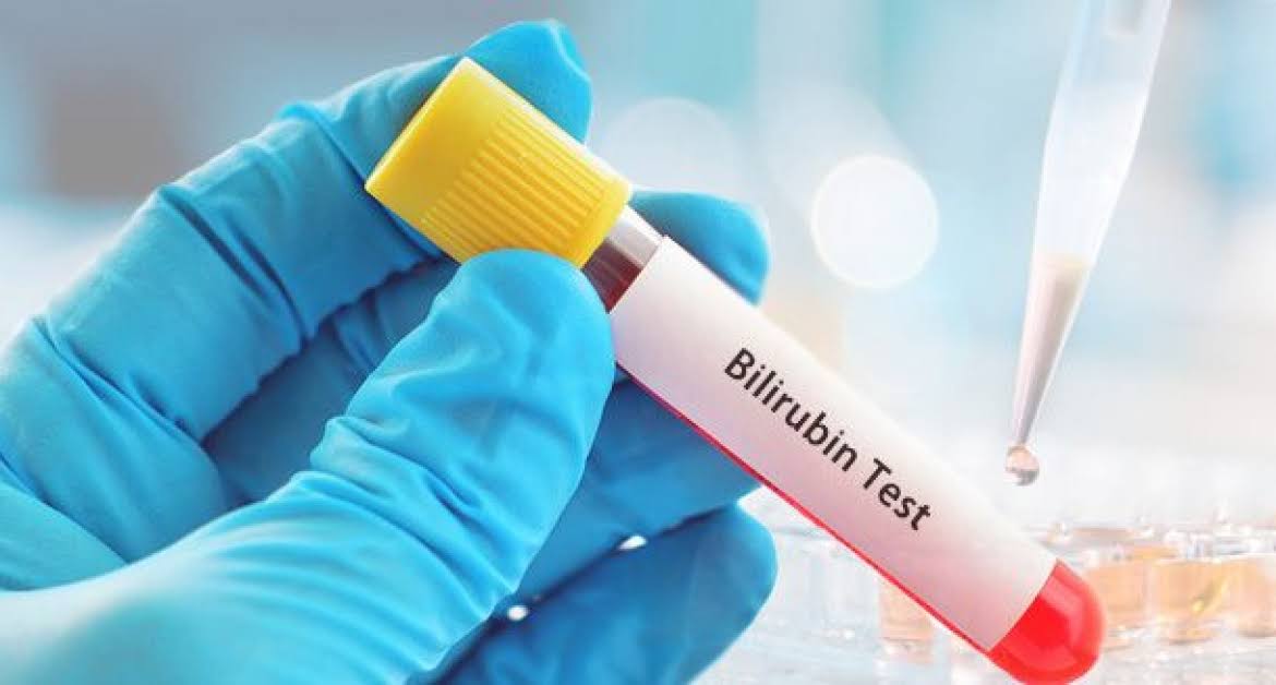 BILLIRUBIN - TOTAL product image