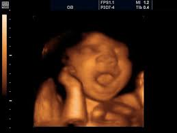 Sleepy Baby Boy At 32wks Ultrasound Pictures 3d Ultrasound 3d Ultrasound Pictures