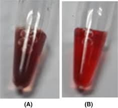 Image result for G6PD Deficiency Detection