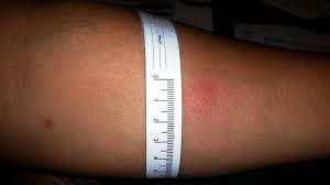 A mantoux tuberculin skin test gives you clear answers on your tb status. The Fine Art Of Administering A Tuberculin Skin Test Pulmonology Advisor