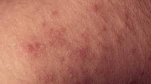 Eczema is a term for a group of conditions that make your skin inflamed or irritated. Eczema Atopic Dermatitis Types Causes Treatment And More