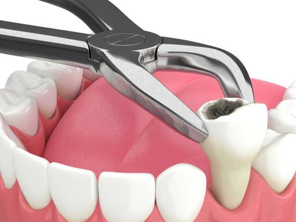 Tooth Extraction product image
