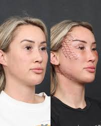 Here we can see Hannah, 3 days after surgery with the surgical net and  swipe to see without it. She desired lateral brow to be elevated, slight  slant of the eyes, midface