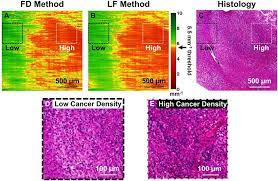 Explore the latest publications in brain cancer, and find brain cancer experts. En Face Oct Attenuation Colormaps Of An Ex Vivo Freshly Resected Human Download Scientific Diagram