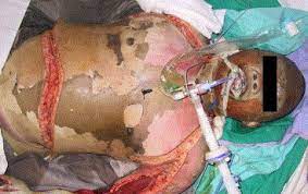 Avoid incisions along flexural creases of joints. Decompression Not Escharotomy In Acute Burns Sciencedirect