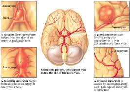 Most brain aneurysms produce no symptoms until they become large, begin to leak blood, or burst. Brain Aneurysm Gwinnett Medical Center