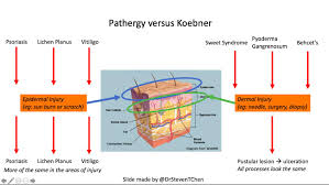 Pathergy can also occur at the site of surgical incisions and cause ulcerations. Pathergy Versus Koebner Dr Steven Chen Https Twitter Com Drsteventchen Pathergy Grepmed
