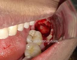 How much does wisdom teeth removal cost? Care To Be Taken Immediately After Wisdom Tooth Extraction