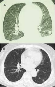 Both costophrenic angles are obliterated indicating bilateral pleural effusion. Pleural Effusion As An Initial Manifestation In A Patient With Primary Pulmonary Monoclonal B Cell Lymphocyte Proliferative Disease Respiratory Research Full Text