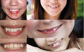 6 Quick Examples Of Yaeba Teeth I Actually Sort Of Have This I Have The Little Fangs Naturally But My Teeth Are Straig Teeth Canine Tooth Teeth Braces