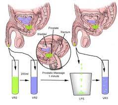 Prostate massage techniques that have helped tens of thousands of men. Prostatitis Pre And Post Massage Test Hackteria Wiki