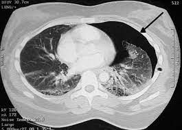 Pneumothoraces on ct are rims of gas (black) around the edges of the lung which may track up the fissures. File Pneumothorax Ct Jpg Wikipedia