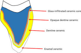 Start studying all ceramic restoration. All Ceramic Restorations A Review Of The Literature Sciencedirect