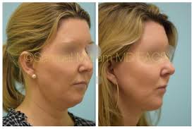 This 49 Year Old Woman Is Shown Before And One Year After Deep Plane Facelift Chin Augmentation Rhinoplasty And D Facial Plastic Hair Transplant Rhinoplasty