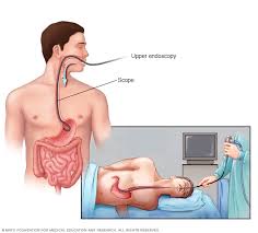 A hiatal hernia occurs when a portion of the stomach prolapses through the diaphragmatic esophageal hiatus. Hiatal Hernia Diagnosis And Treatment Mayo Clinic
