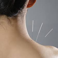 Pin On Acupuncture