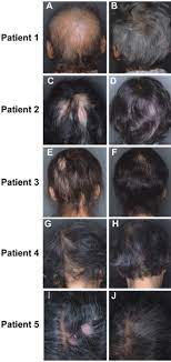 What we know about zinc deficiency largely comes from the study of people with a genetic disorder called acrodermatitis enteropathica. Oral Zinc Therapy For Zinc Deficiency Related Telogen Effluvium Karashima 2012 Dermatologic Therapy Wiley Online Library