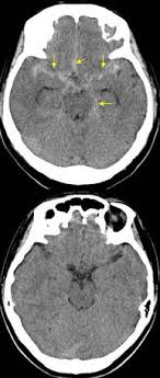 Contribute to ugvf2009/miles development by creating an account on github. ãã‚‚è†œä¸‹å‡ºè¡€ Moriyama Neurosurgical Clinic ãƒšãƒ¼ã‚¸