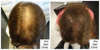 In einem forum zu haarausfall oder haartransplantation können sie sich informieren und mit anderen betroffenen austauschen. Haartransplantation Forum Haartransplantation Allgemein Micro Pigmentation Bei Frau Prohairclinic