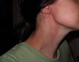 This article outlines the symptoms and signs of throat cancer, as well as its causes and process for diagnosis. Feels Like Throat Closing Up After Everytime I Eat Jasperpenn S Blog