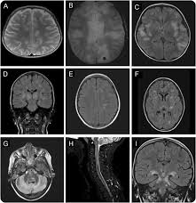 A disease that damages myelin (= a white fatty substance that covers some nerves): Differential Diagnosis And Evaluation In Pediatric Inflammatory Demyelinating Disorders Neurology