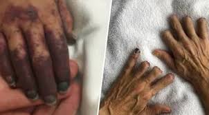 You cannot catch sepsis from another person. Signs Of Sepsis Mum Who Lost Legs Lists Symptoms Everyone Should Know Nz Herald