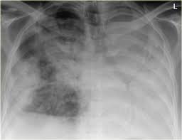 Image result for Air Bronchogram