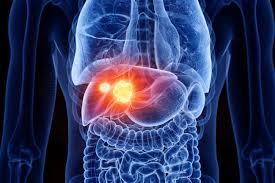 Steatotic liver disease and the link to liver cancer | Roswell Park  Comprehensive Cancer Center - Buffalo, NY