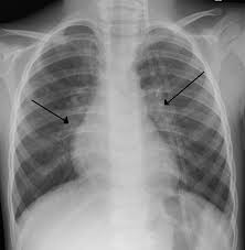 Symptômes, causes, médicaments, diagnostic, erreurs de diagnostic et symptôme checker. Bronchiolite Wikipedia