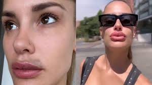 Gala Caldirola impactó con resultado de procedimiento estético para  "naturalizar"