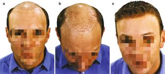 Wigs and Hair Prosthesis