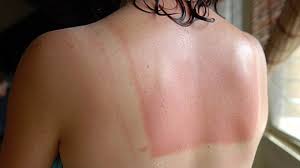 Image result for Sunburn