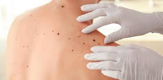 Resultado de imagem para melanoma