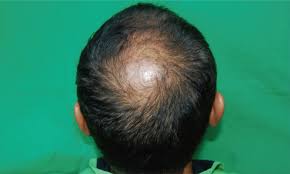 Tressless (tress·less, without hair) is a support community for males and females coping with hair loss. A 44 Year Old Male With Typical Vertex Alopecia All Vertex Types Of Download Scientific Diagram