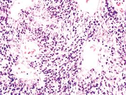 The Vulva And Vagina Chapter 37 Silverberg S Principles And Practice Of Surgical Pathology And Cytopathology Bullous pemphigoid is the most common disease amongst all autoimmune blistering diseases. the vulva and vagina chapter 37