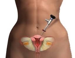 Medical illustration of laparoscopic gynecological surgery with scope and pelvic organs