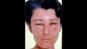 The most common symptom is tingling in the mouth and throat that starts as soon as you begin eating and goes very quickly. Food Allergy Rash Other Symptoms Management And Treatments