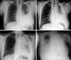 One of the presenting symptoms can be pleural effusion, or excess fluid in the . Poster Anterior Cxr Follow Up Images Of Progressive Malignant Pleural Download Scientific Diagram