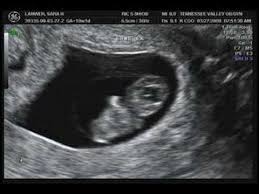 Maybe you would like to learn more about one of these? 6 Weeks 3 Days Pregnant Ultrasound Novocom Top