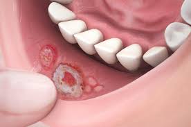 Image result for mouth ulcer on tongue)