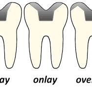 Inlays and onlays - Wikipedia
