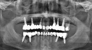 Dites Adieu Aux Implants Dentaires Et Faites Pousser Vos Propres Dents En Seulement 9 Semaines Implants Dentaires Implant Dentaire Implant
