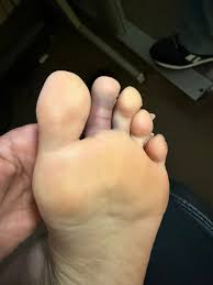 Metatarsal stress fracture symptoms and treatment?