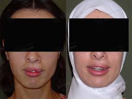 Te contamos todo sobre sus causas, tipos labio leporino y paladar hendido: Cirugia De Labio Leporino En Adultos Estilos De Labios