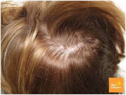 Checkdo you have skin cancer? Skin Cancer On Scalp Skin Check Waskin Check Wa