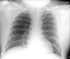 Poland syndrome refers to a congenital unilateral absence of the pectoralis major and minor muscles and is a recognized cause of unilateral hyperlucent hemithorax. Poland Syndrome Images Diagnosis Treatment Options Answer Review Thoracic Imaging