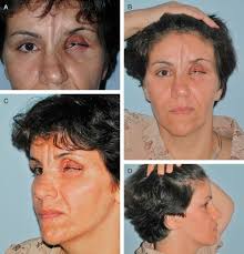 Parry-Romberg syndrome: an unusual case of lagophthalmus and exposure  keratopathy